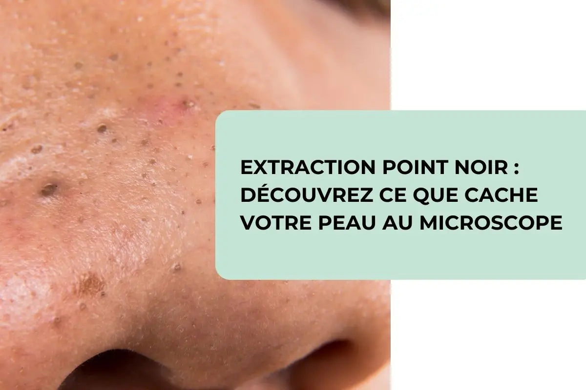 Extraction Point Noir : Techniques, Outils et Conseils d’Experts ...